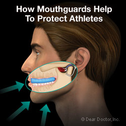 Sports mouthguards
